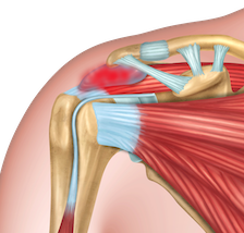 Physiotherapy subacromial decompression leaflet